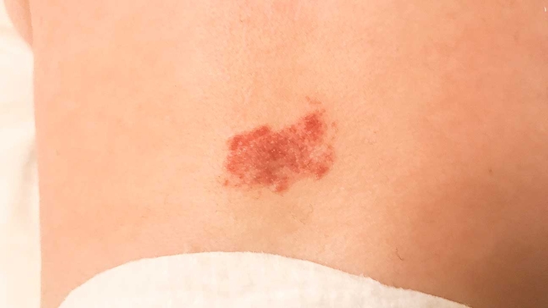 Vết bớt đỏ thường xuất hiện bẩm sinh