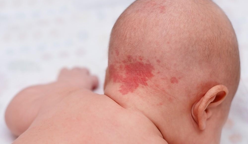 Đến nay vẫn chưa xác định được nguyên nhân chính xác làm xuất hiện bớt đỏ trên da