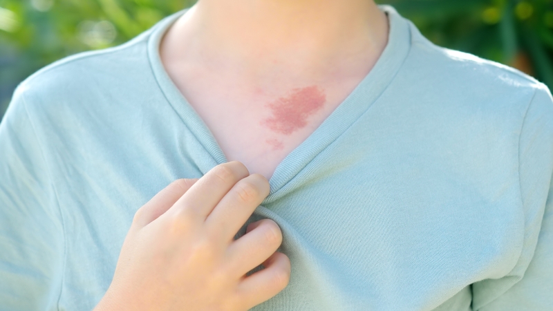 Vết bớt là gì? Chúng có gây hại không? 1