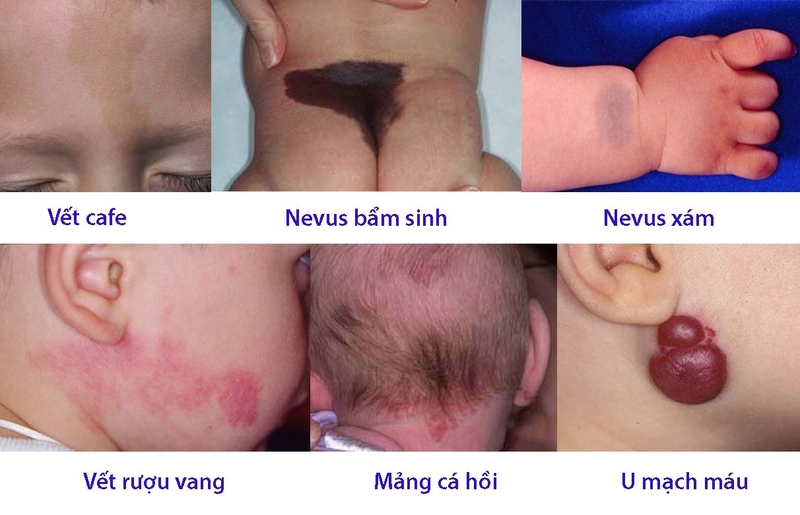Vết bớt là gì? Chúng có gây hại không? 2