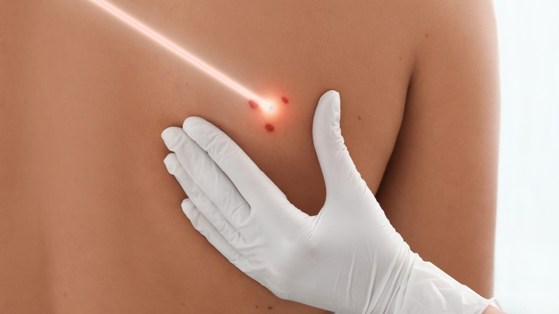 Vết bớt là gì? Chúng có gây hại không? 4