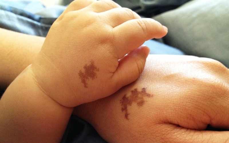 Vết bớt ở trẻ sơ sinh là gì? Có nguy hiểm không? 3