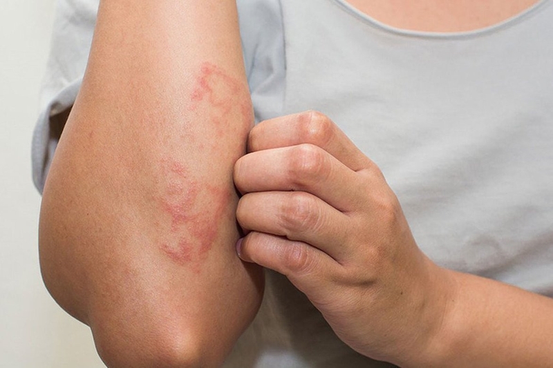 Hạn chế gãi vùng bị đốt dù có cảm giác ngứa đến mức nào