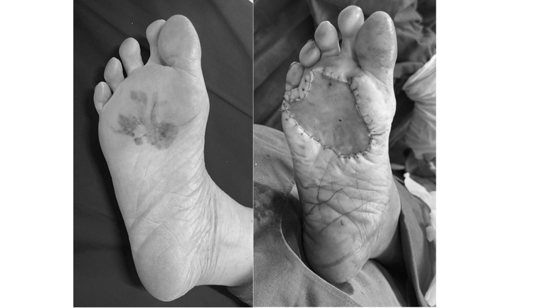 Chân bệnh nhân trước và sau phẫu thuật cắt bỏ khối u