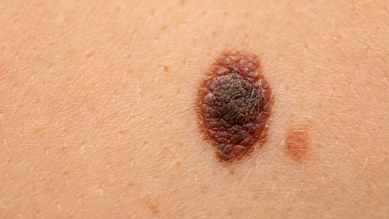 Melanoma là một trong những loại ung thư da nguy hiểm nhất