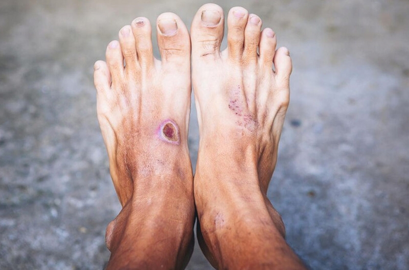 Vết loét tiểu đường, hiểu đúng để nâng cao việc điều trị