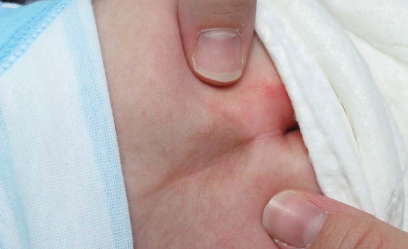 Vết lõm xương cùng là gì? Chẩn đoán như thế nào? 1