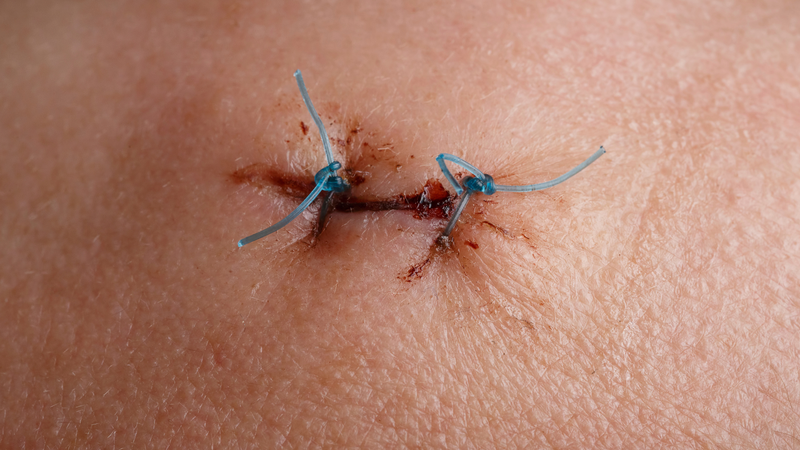 Vết mổ bị sưng cứng bên trong là tình trạng mô dưới da trở nên chắc hoặc gồ khi sờ