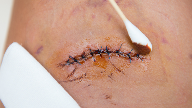 Tăng lưu lượng máu và hoạt động miễn dịch gây sưng nhẹ, căng tức và nóng tại chỗ