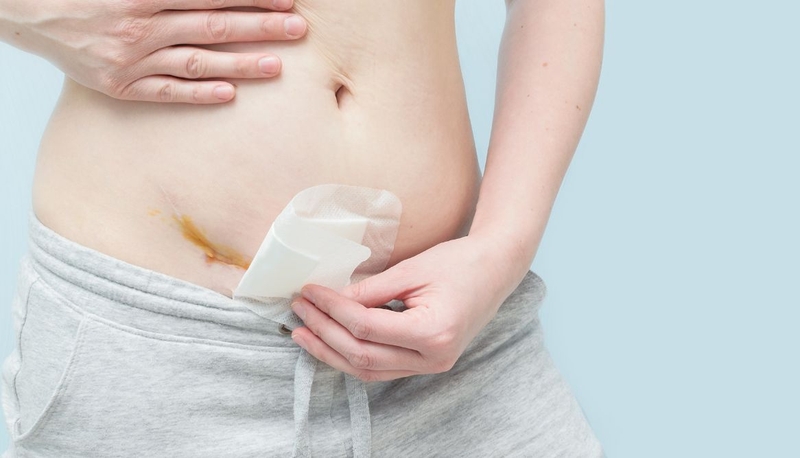 Vết mổ đẻ lần 2 bao lâu thì lành? Cách giúp vết mổ đẻ nhanh lành 3