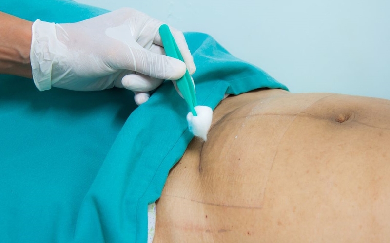 Vết mổ đẻ lần 2 bao lâu thì lành? Cách giúp vết mổ đẻ nhanh lành 2