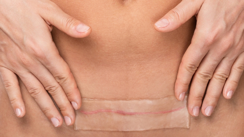 Vết mổ sau sinh bị hở: Nguyên nhân, dấu hiệu và biện pháp phòng ngừa 1