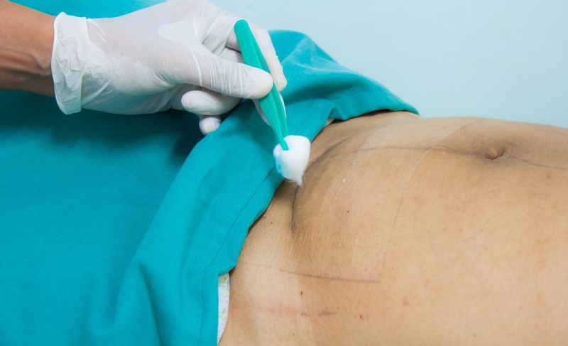 Vết mổ sau sinh bị ngứa: Nguyên nhân và cách khắc phục 1