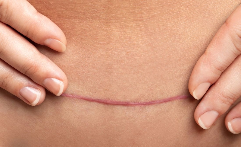 Vết mổ sau sinh bị ngứa: Nguyên nhân và cách khắc phục 3