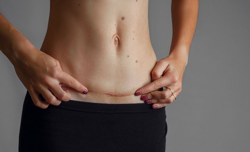 Vết mổ sau sinh bị ngứa: Nguyên nhân và cách khắc phục 4