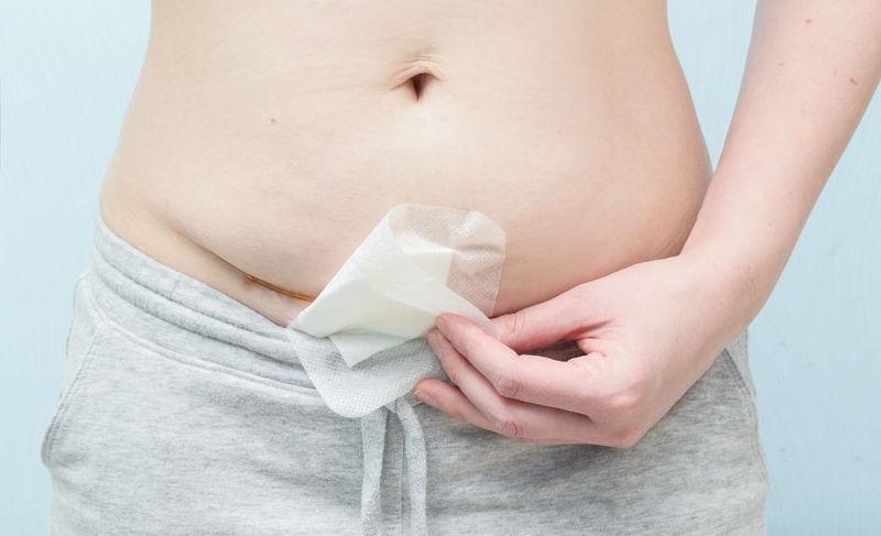 Vết mổ sau sinh bị ngứa: Nguyên nhân và cách khắc phục 2