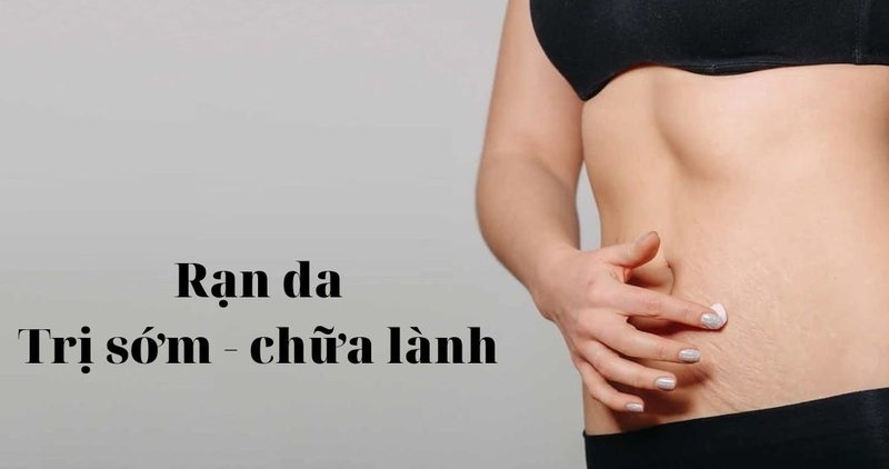 vết rạn da sau sinh bị đau 3