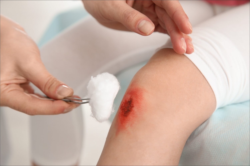 Làm sạch và cầm máu ngay sau khi bị thương