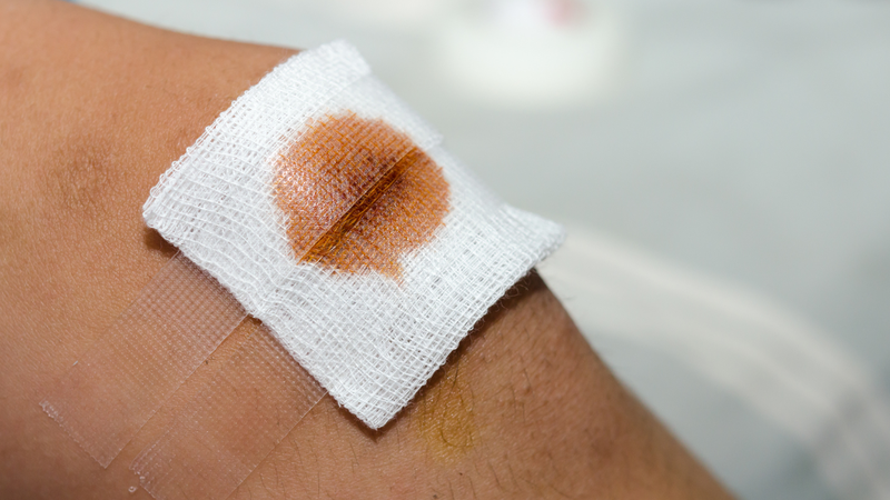 Vết thương hở là tình trạng phổ biến nhưng tiềm ẩn nhiều rủi ro nếu không được xử lý đúng cách