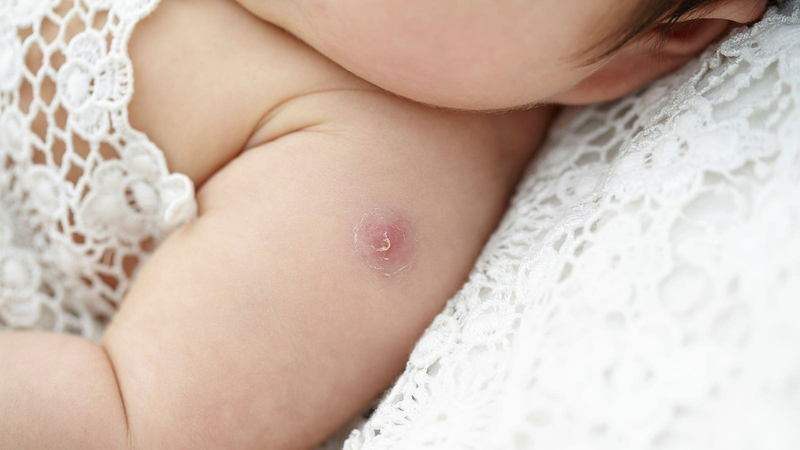 Vết tiêm lao bị mưng mủ nhiều lần phải làm sao?4