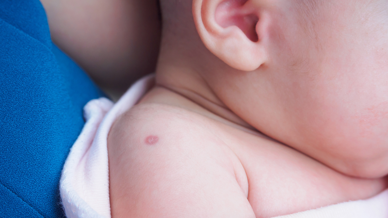 Vết tiêm lao mưng mủ sau 4 tháng có sao không? 2