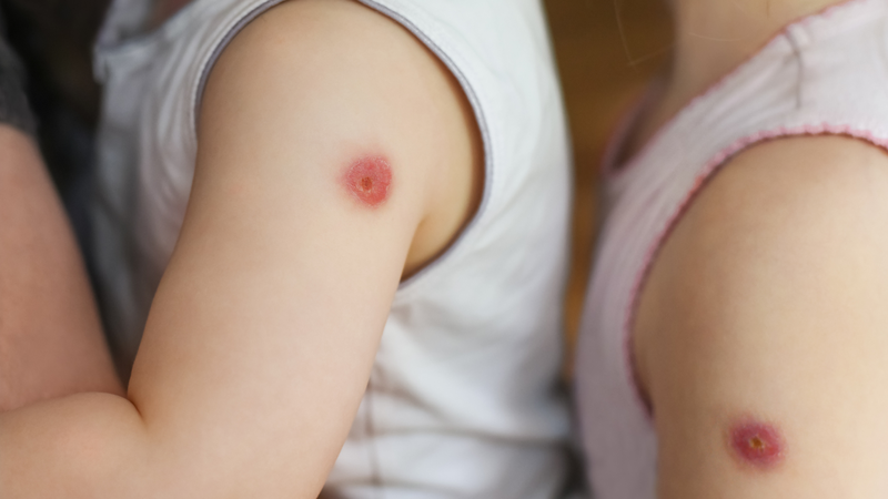 Vết tiêm lao mưng mủ sau 4 tháng có sao không? 3