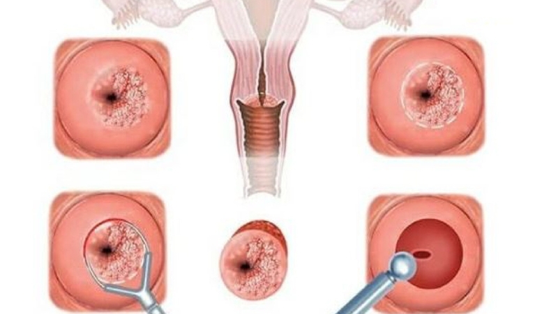 Vết trắng cổ tử cung có phải ung thư không? 2