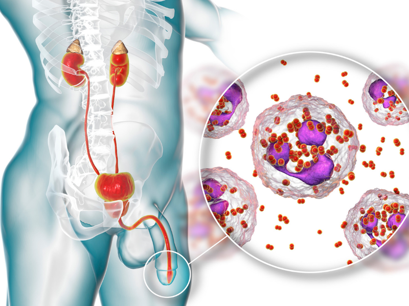 Viêm hậu môn là gì? Triệu chứng và cách phòng ngừa viêm hậu môn 5