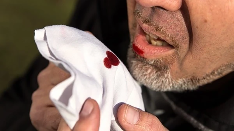 Vị giác có mùi máu nguyên nhân do đâu? 1