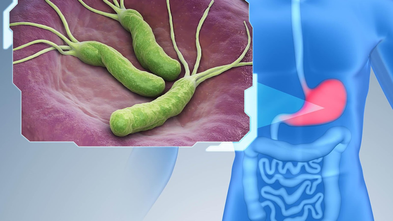 Vi khuẩn H.P gây bệnh tiêu hóa gì và lây qua đường nào? 1