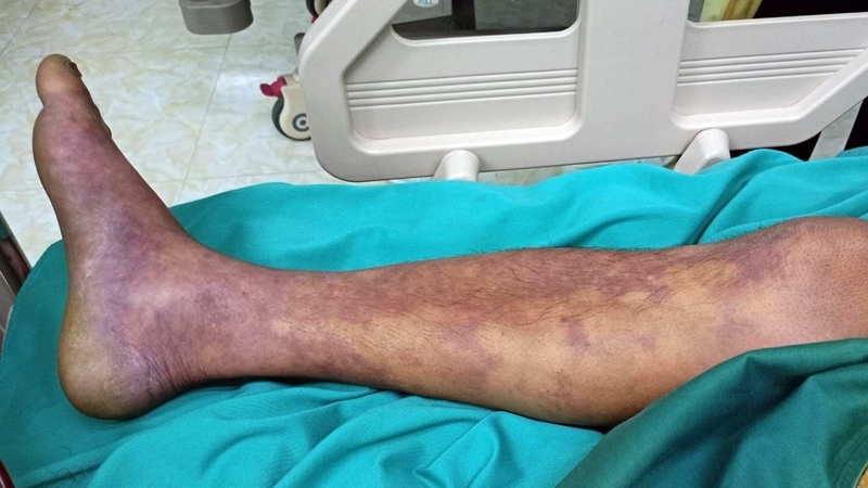 Vi khuẩn liên cầu lợn là gì? Nguy hiểm như thế nào 2