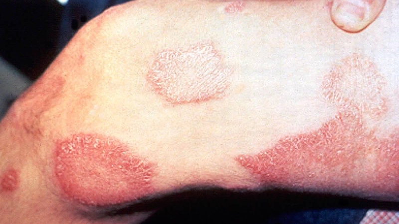 Xuất hiện các mảng da nhạt màu hoặc đỏ sậm khi vi khuẩn tấn công