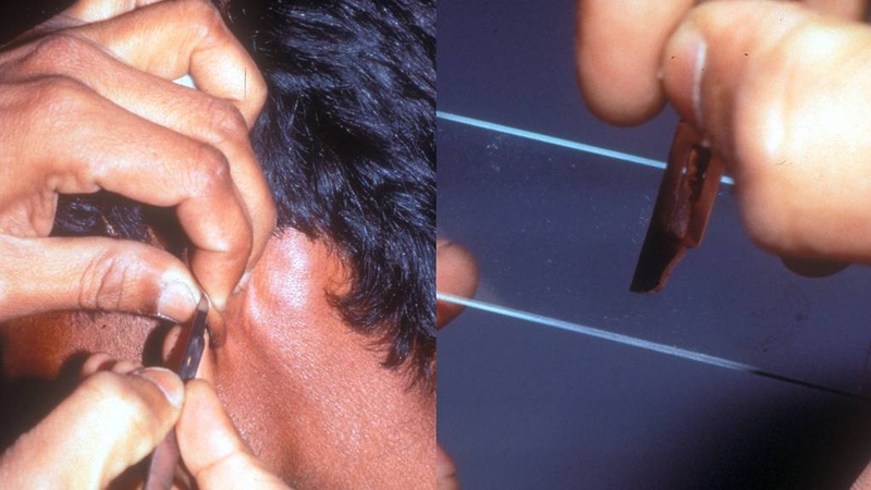 Sinh thiết da cũng được áp dụng để xác định chính xác bệnh