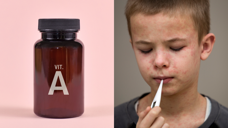 Vì sao bệnh nhân mắc bệnh sởi cần bổ sung vitamin A? 1