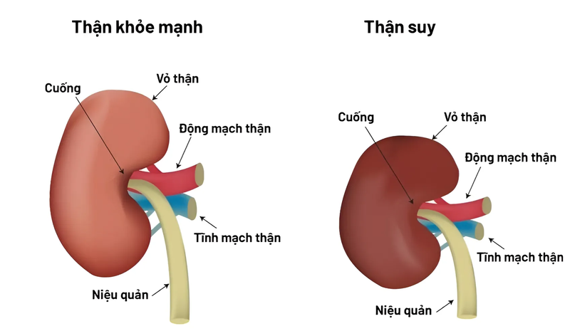 Vì sao bệnh suy thận đang có xu hướng trẻ hóa? 2