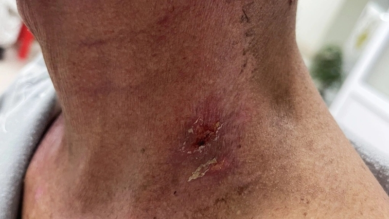 Cách xử lí viêm da do xạ trị ung thư 1