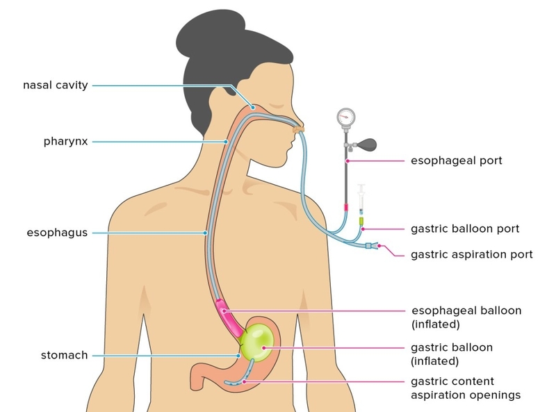Vì sao cần đặt ống thông dạ dày cho trẻ sơ sinh? Cách chăm sóc trẻ khi đặt ống 1