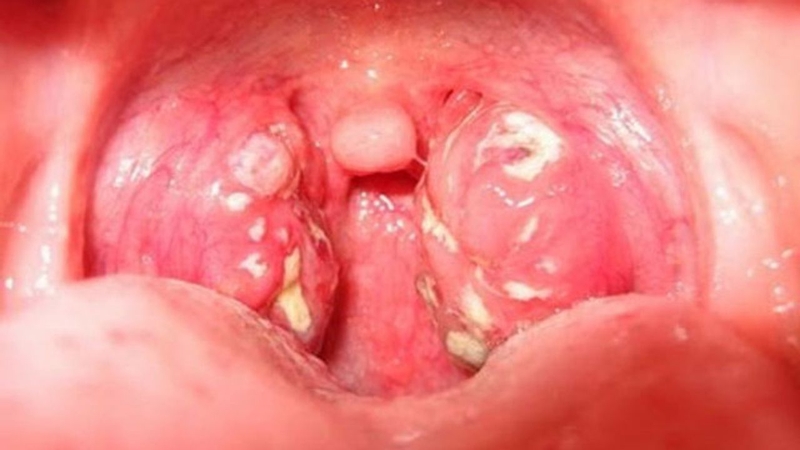 Vì sao đã phẫu thuật cắt amidan vẫn bị vướng ở cổ?1