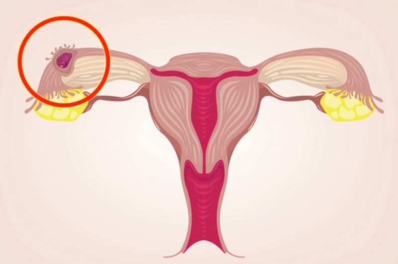 Vì sao đặt vòng tránh thai vẫn có thai? Mang thai khi đặt vòng tránh thai có an toàn? 4