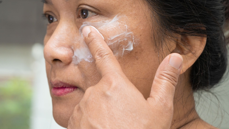 Kích ứng da khi dùng kem trị nám là một trong những nguyên nhân thường gặp của trị nám các vết nám lại đậm hơn