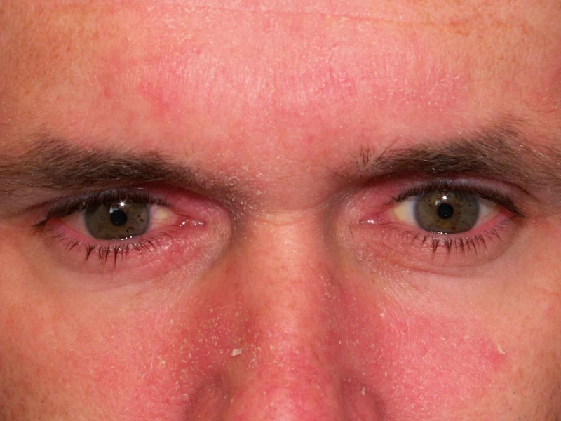 Vì sao lông mày bị rụng? Cách khắc phục hiệu quả?2