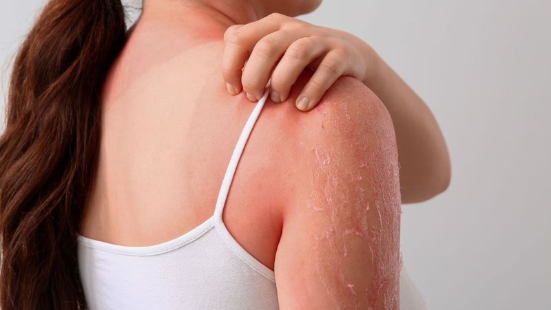 Không khó để nhận ra dấu hiệu người bị lupus ảnh hưởng bởi ánh nắng