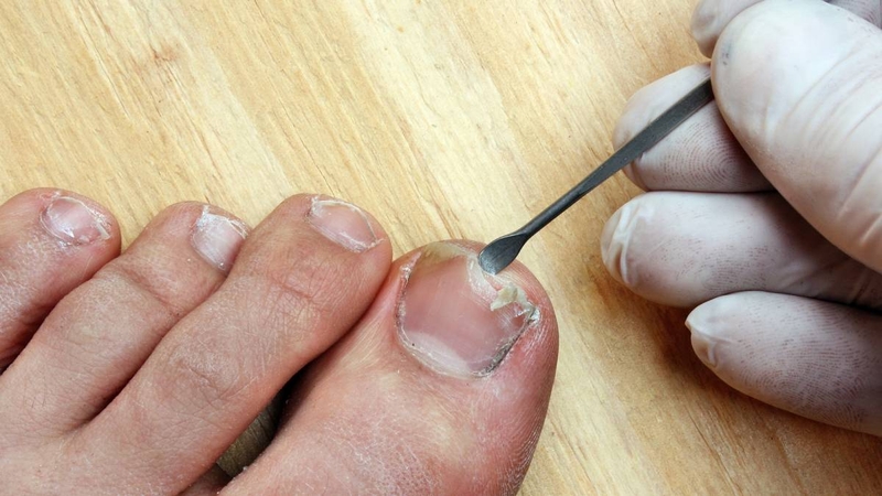 Vì sao móng chân bị tách lớp? Cách khắc phục tình trạng này là gì? 1