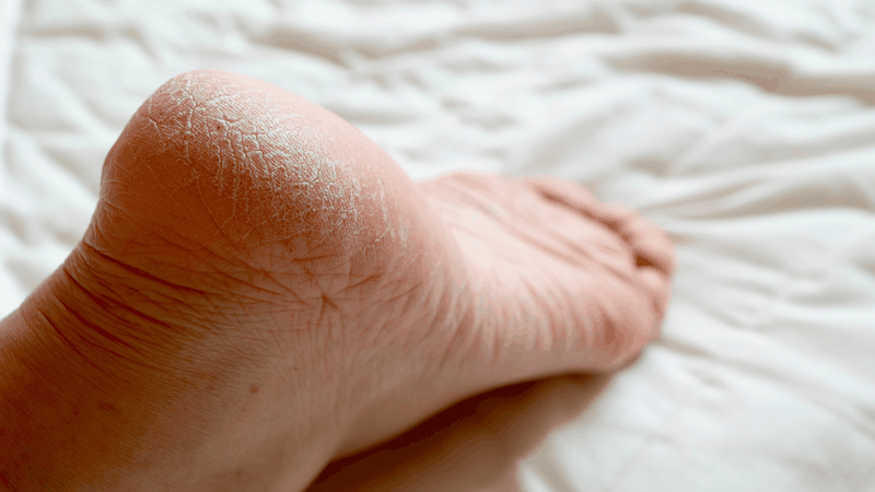 Vì sao mùa lạnh hay bị nứt gót chân?