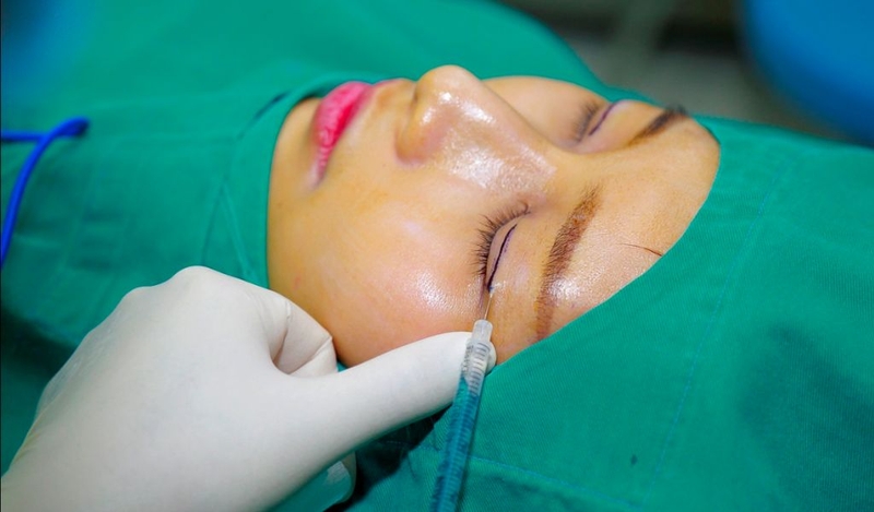 Vì sao nhấn mí bị nổi cục? Có khắc phục được không và cách phòng ngừa 2