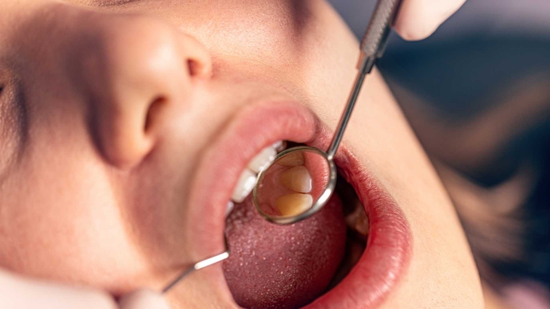 Ổ răng khô là một biến chứng có thể gây đau dữ dội sau nhổ răng khôn