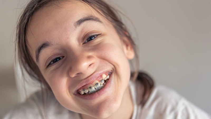 "Kéo cụm 4 răng cửa mất bao lâu?" là thắc mắc phổ biến