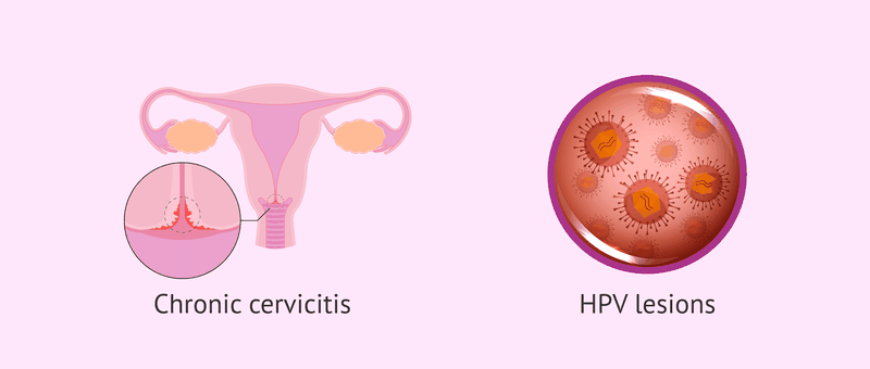 Vì sao phụ nữ lại dễ bị viêm cổ tử cung mãn tính? Cách phòng bệnh hiệu quả1