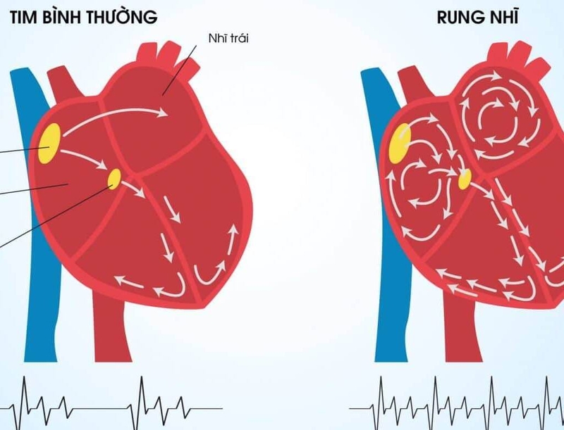 Vì sao rung nhĩ gây huyết khối? Các loại thuốc chống đông dùng trong rung nhĩ