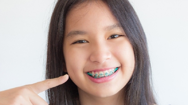 Vì sao sắp tháo niềng mà răng vẫn cụp? 1